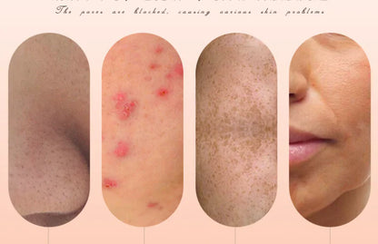 Powerful Electric Blackhead Remover for Home Use